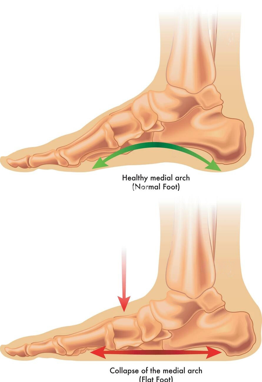 medical illustration of flat feet
