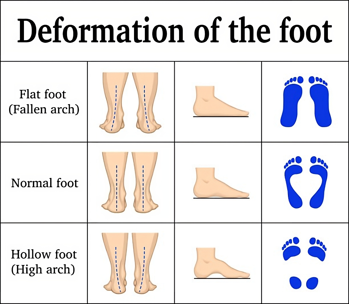 flat feet deformation