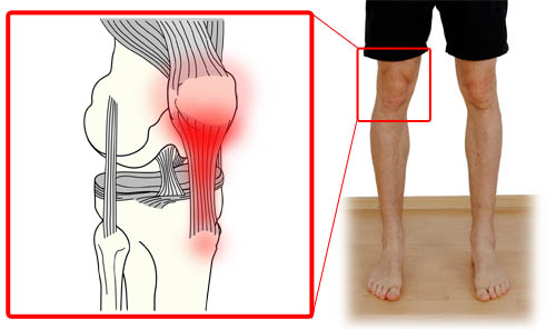 jumpers knee illustration